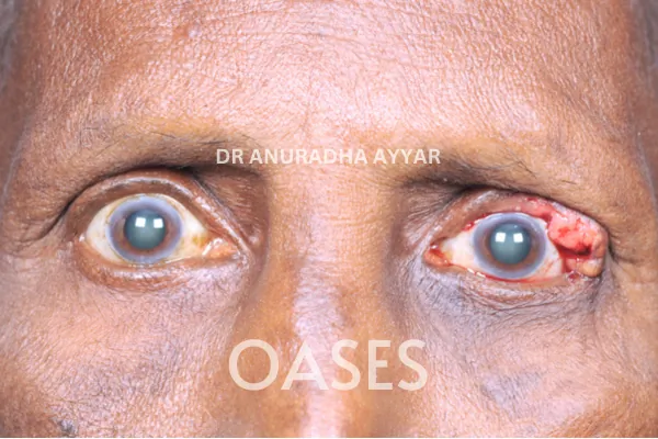 Eye-lid cancer Treatment at Oases Eye Care Center