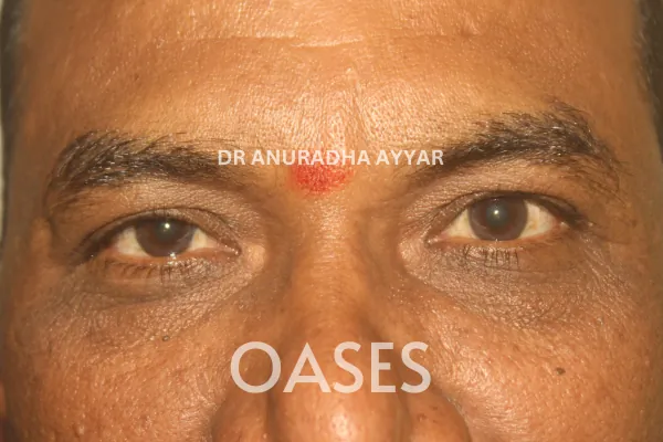 Orbital Tumours Treatment at Oases Eye Care Center