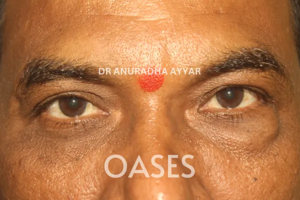 Orbital Tumours Treatment at Oases Eye Care Center