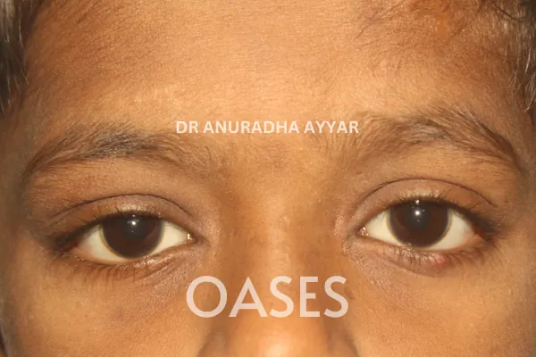 Orbital Tumours Treatment at Oases Eye Care Center