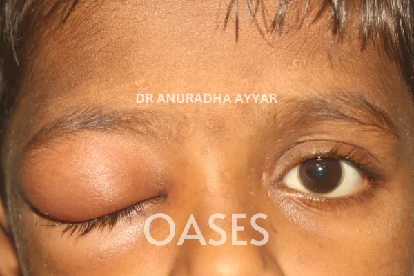 Orbital Tumours Treatment at Oases Eye Care Center