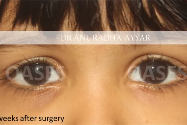 Orbital Tumours Treatment at Oases Eye Care Center