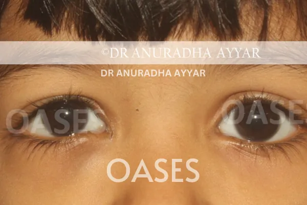 Orbital Tumours Treatment at Oases Eye Care Center