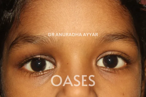Orbital Tumours Treatment at Oases Eye Care Center