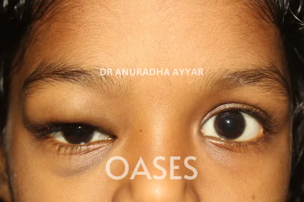 Orbital Tumours Treatment at Oases Eye Care Center