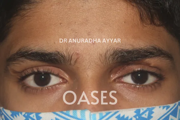 Orbital Tumours Treatment at Oases Eye Care Center