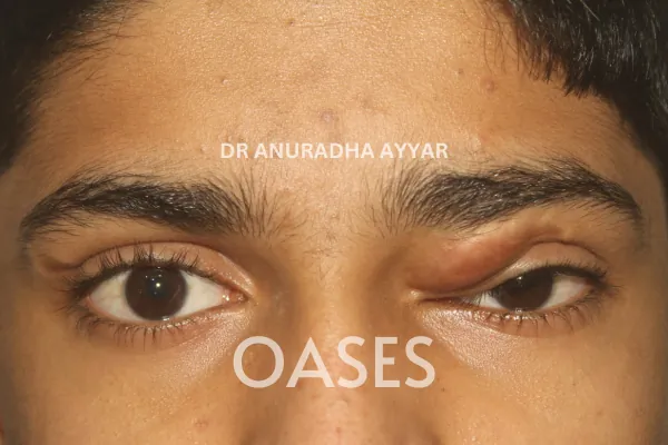 Orbital Tumours Treatment at Oases Eye Care Center