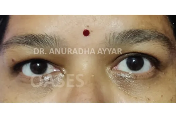Orbital Tumours Treatment at Oases Eye Care Center