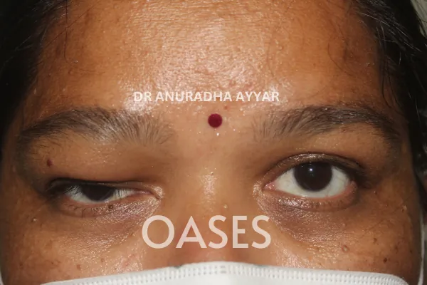 Orbital Tumours Treatment at Oases Eye Care Center