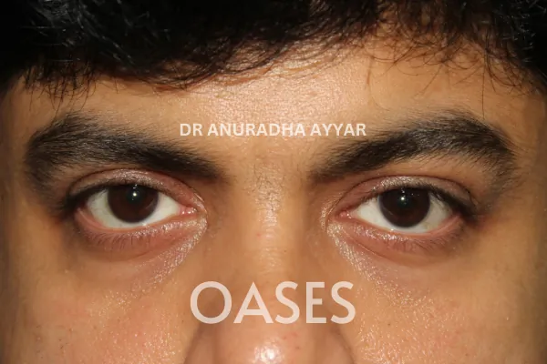 Ptosis Treatment at Oases Eye Care Center