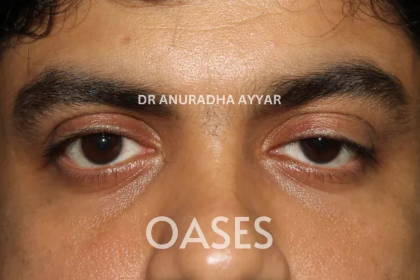 Ptosis Treatment at Oases Eye Care Center
