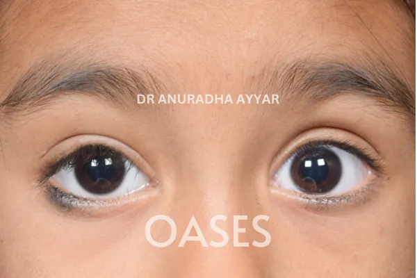 Ptosis Treatment at Oases Eye Care Center