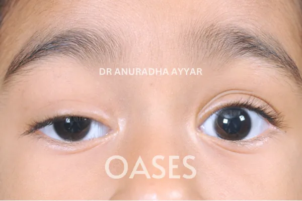 Ptosis Treatment at Oases Eye Care Center