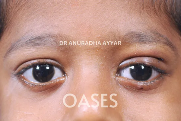 Ptosis Treatment at Oases Eye Care Center