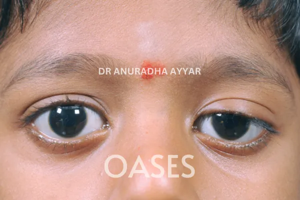 Ptosis Treatment at Oases Eye Care Center