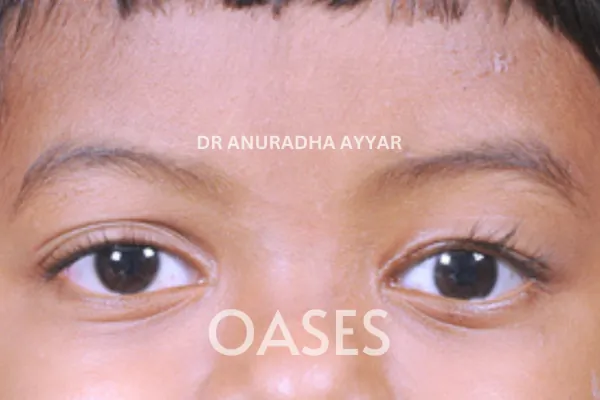 Ptosis Treatment at Oases Eye Care Center