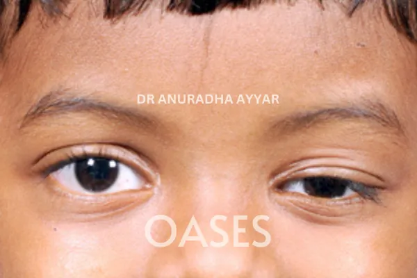 Ptosis Treatment at Oases Eye Care Center