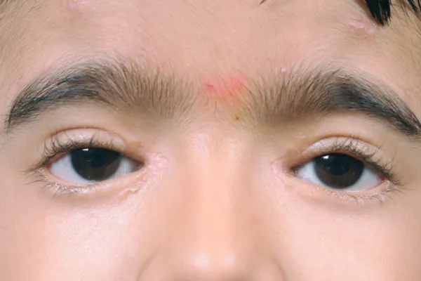 Ptosis Treatment at Oases Eye Care Center