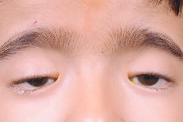 Ptosis Treatment at Oases Eye Care Center
