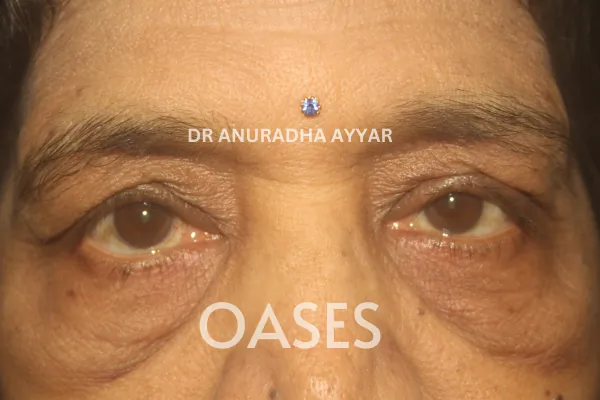 Ptosis Treatment at Oases Eye Care Center
