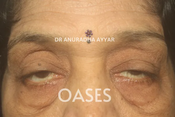 Ptosis Treatment at Oases Eye Care Center