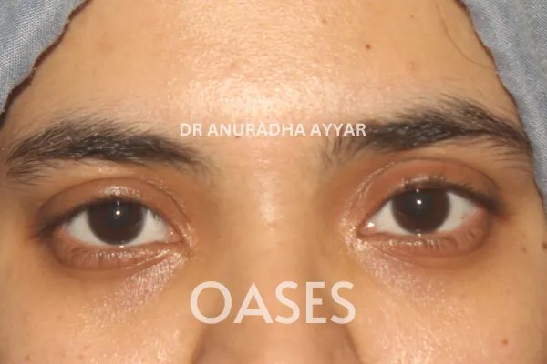 Ptosis Treatment at Oases Eye Care Center
