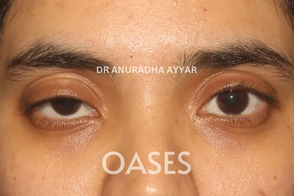 Ptosis Treatment at Oases Eye Care Center
