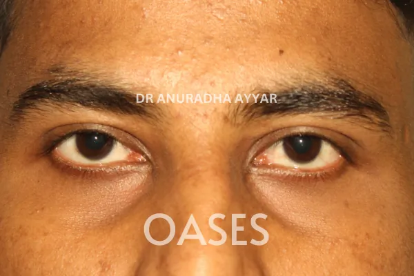 Ptosis Treatment at Oases Eye Care Center