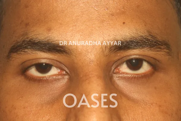 Ptosis Treatment at Oases Eye Care Center