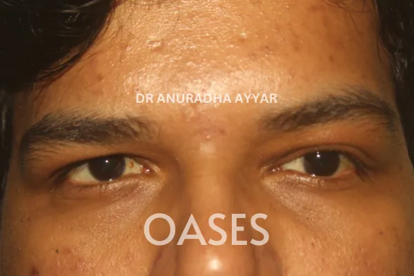 Ptosis Treatment at Oases Eye Care Center