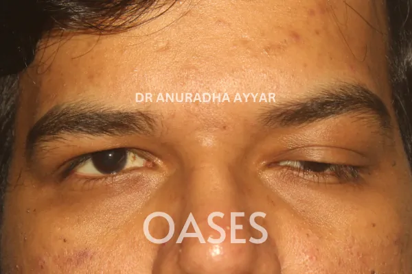 Ptosis Treatment at Oases Eye Care Center