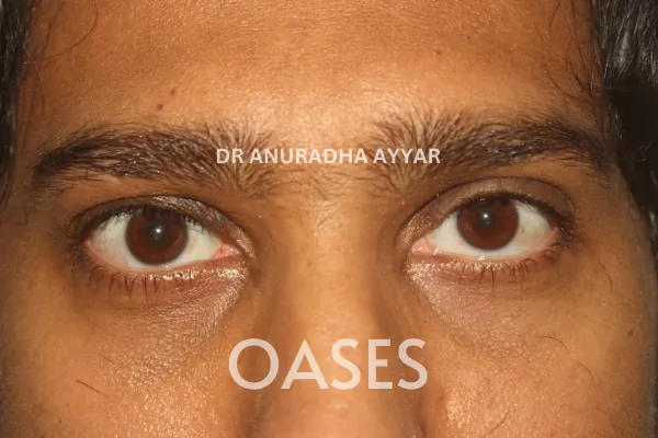 Ptosis Treatment at Oases Eye Care Center