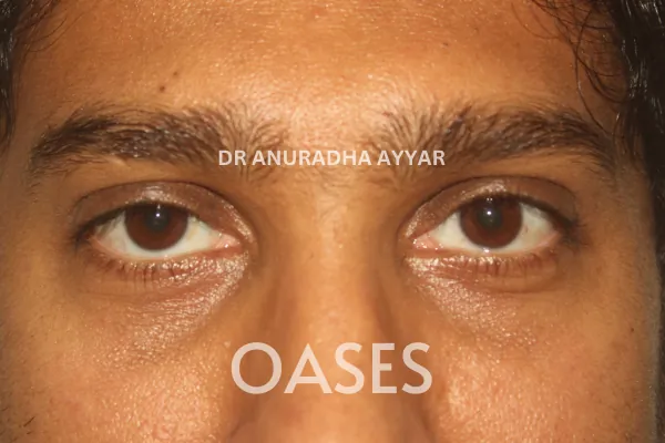 Ptosis Treatment at Oases Eye Care Center