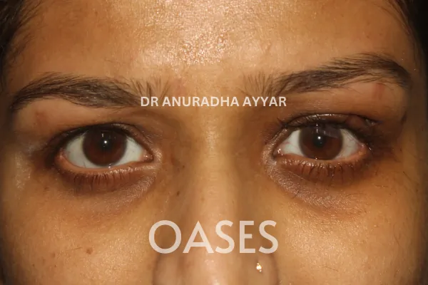 Ptosis Treatment at Oases Eye Care Center