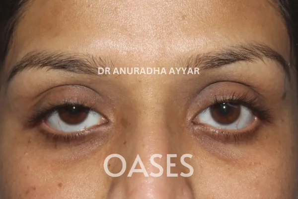 Ptosis Treatment at Oases Eye Care Center
