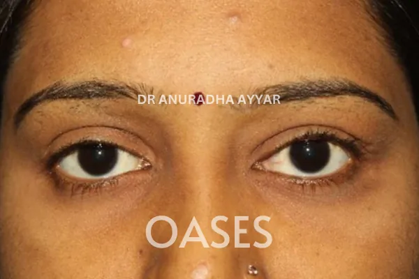 Ptosis Treatment at Oases Eye Care Center