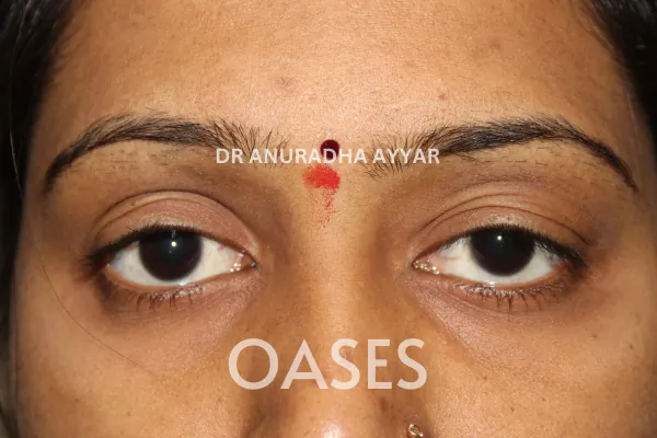 Ptosis Treatment at Oases Eye Care Center