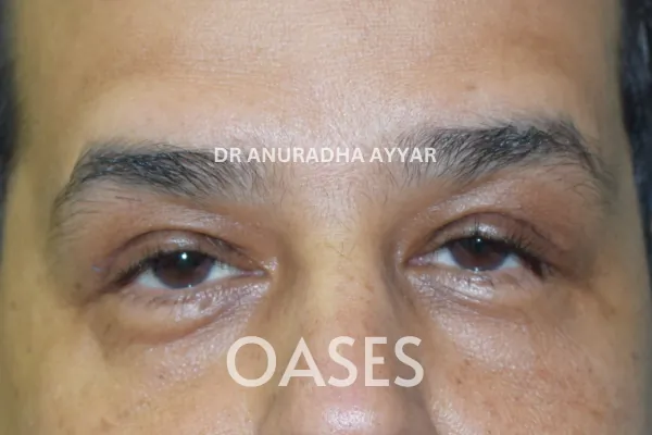 Ptosis Treatment at Oases Eye Care Center