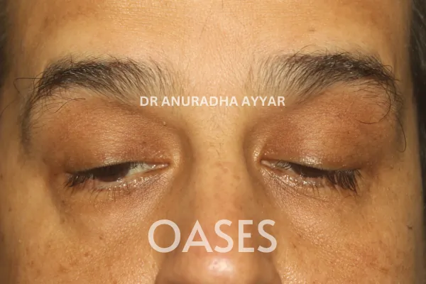Ptosis Treatment at Oases Eye Care Center