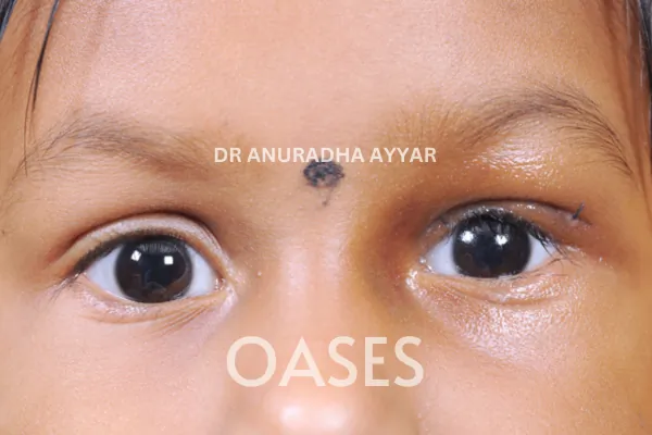Ptosis Treatment at Oases Eye Care Center