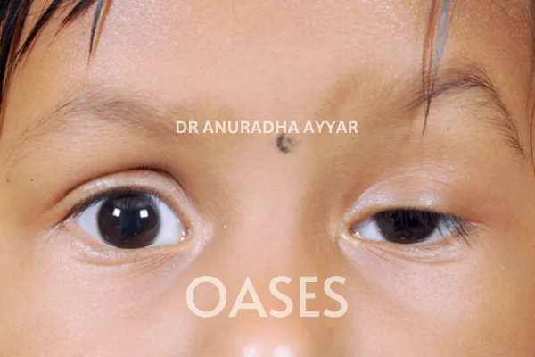 Ptosis Treatment at Oases Eye Care Center