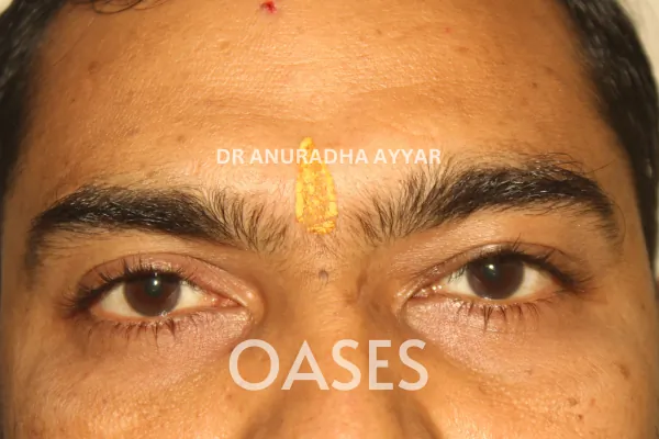 Ptosis Treatment at Oases Eye Care Center
