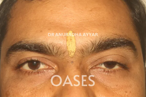 Ptosis Treatment at Oases Eye Care Center