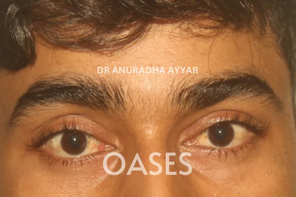 Ptosis Treatment at Oases Eye Care Center