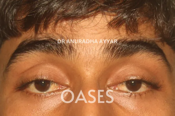 Ptosis Treatment at Oases Eye Care Center