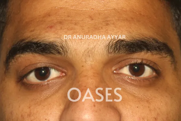 Ptosis Treatment at Oases Eye Care Center