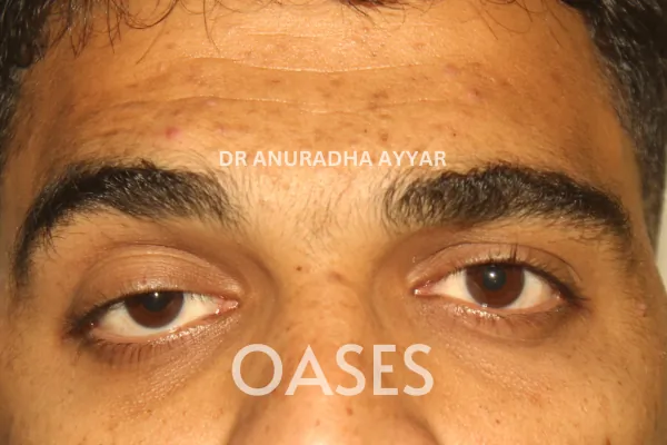 Ptosis Treatment at Oases Eye Care Center
