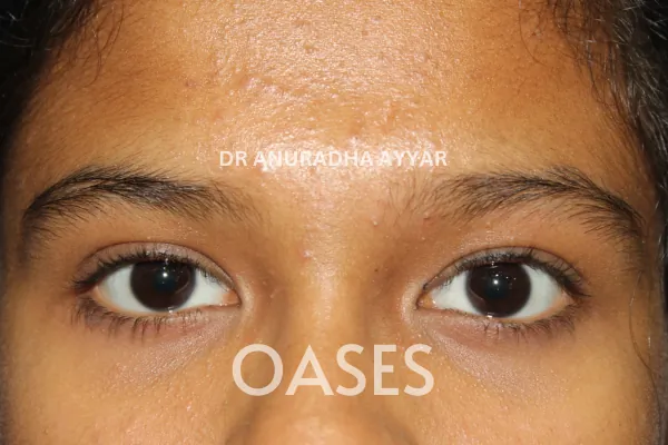 Ptosis Treatment at Oases Eye Care Center