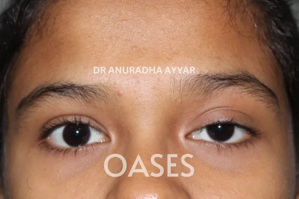 Ptosis Treatment at Oases Eye Care Center