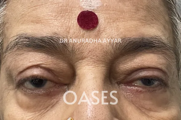 Ptosis Treatment at Oases Eye Care Center
